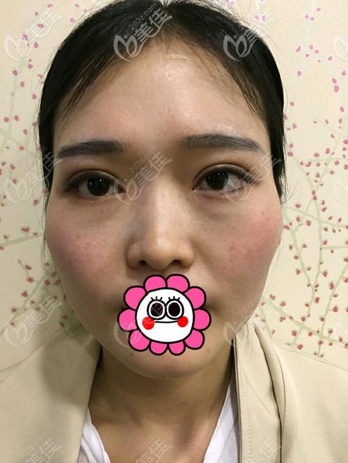 杭州连天美做颧骨内推怎么样有磨骨医生坐诊还挺靠谱的