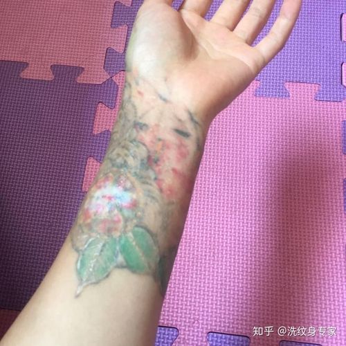贪便宜的不但洗不掉纹身,而且会留下增生疤痕