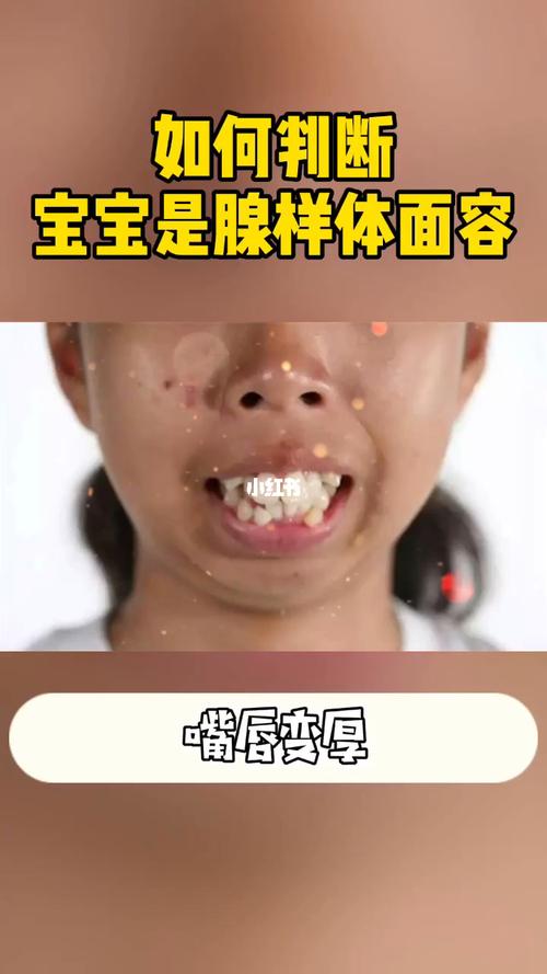 这个视频教你判断宝宝是不是腺样体面容_腺样体面容_母婴_育儿经验