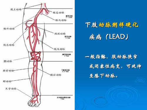 如何筛查诊断下肢动脉阻塞性疾病