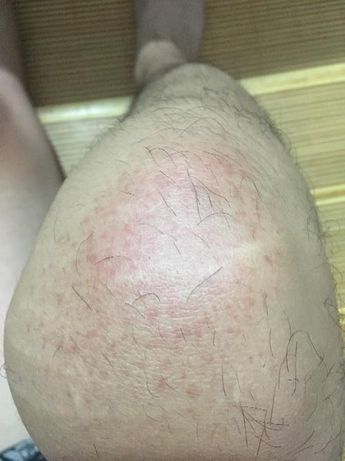膝盖上无缘无故出现了红斑!不痛不痒,什么状况?
