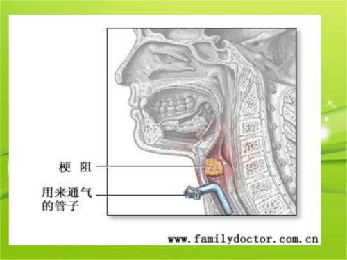 急性喉梗阻的护理.ppt