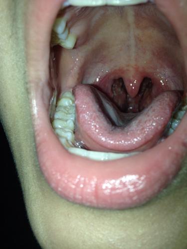 这是白喉吗?喉咙很疼,没有乏力,打喷嚏