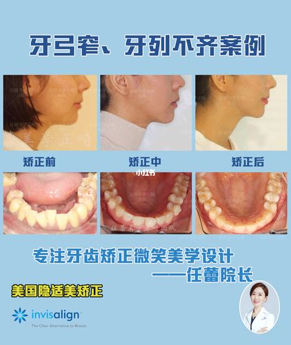 牙弓窄临床上常见到的一种表现,通抄常指上颌第