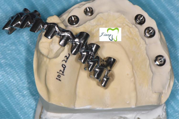 种植牙之纯钛多功能桥架 全瓷修复半口种植牙一例