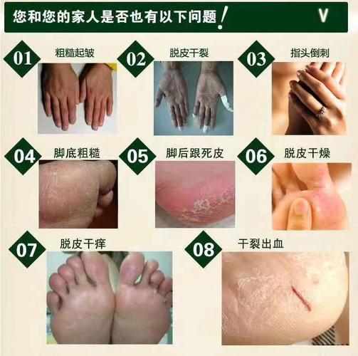 秋冬天手脚干燥脱皮冻疮怎么办?