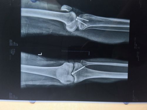 关节镜下髁间棘骨折内固定