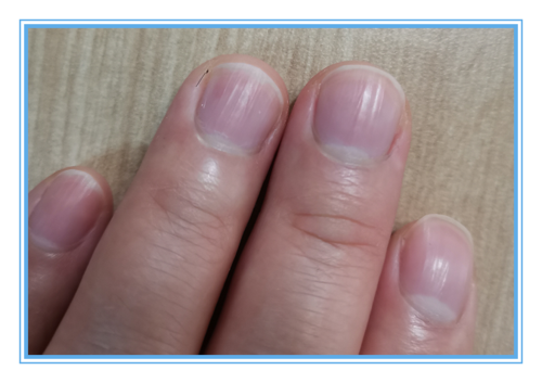 根据指甲的颜色望甲诊病