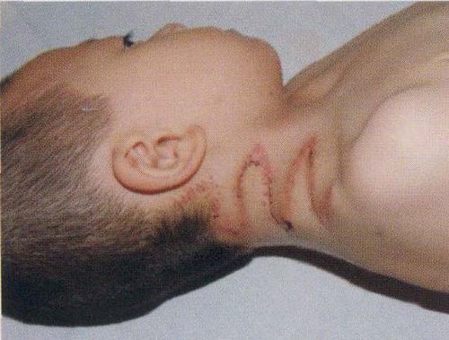 典型病例1:连续z成形术矫正先天性蹼颈畸形