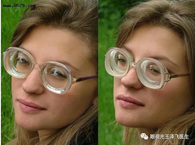 是不是眼镜戴久了,眼睛就会变形,外凸?眼科医生告诉你