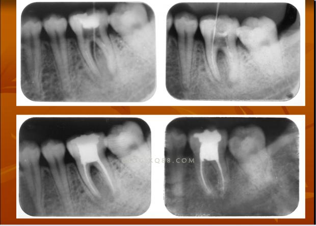 牙病诊疗实用创新技术系列讲座之六/课件展示