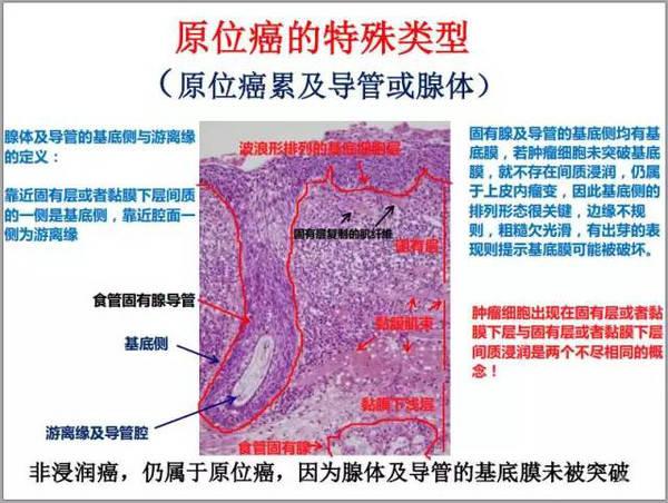 这里补充一个原位癌的特殊类型,原位癌累及导管或腺体.