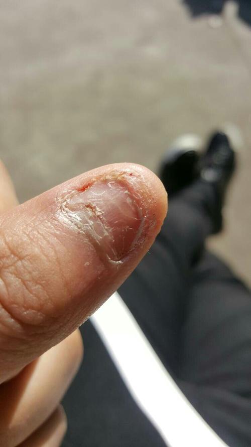 手指甲被车门夹后淤血