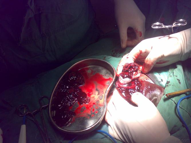 右睾丸外伤破裂