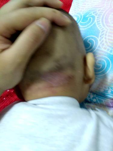 宝宝后脑勺长的什么东西?要怎么处理?急急急.