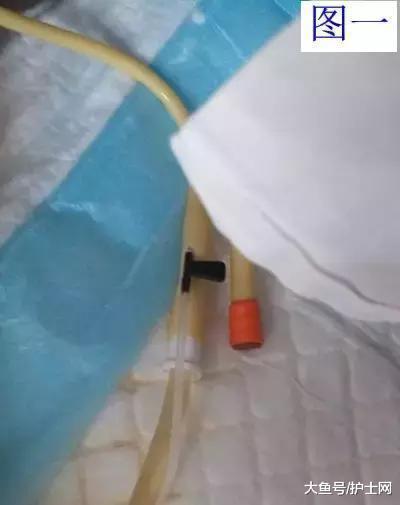 掀开盖被看到护士膀胱冲洗时直接把输液器针头插到导尿管上,并且未用