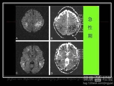 脑白质变性怎么引起的