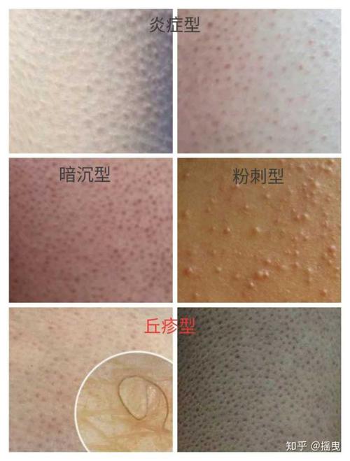 毛囊角质化(鸡皮肤)是否无法改善?