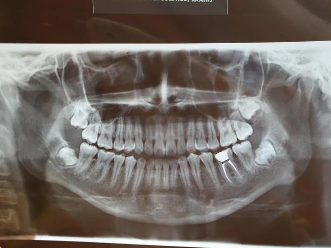 一年前做完根管治疗之后顺便拍了一张牙片