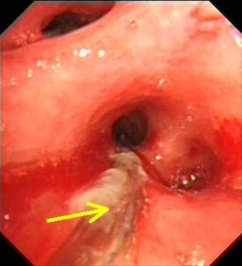 得了支气管扩张能治愈吗? 如何治疗?
