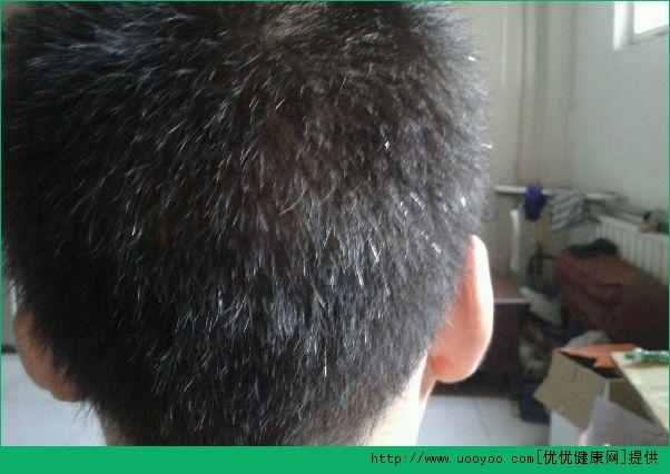长白头发是什么原因?吃什么能变黑?[多图]