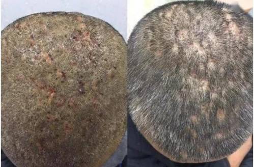 毛囊炎顽固多发,究竟是什么原因引起的?