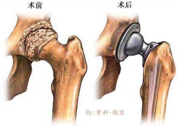 人工髋关节置换术
