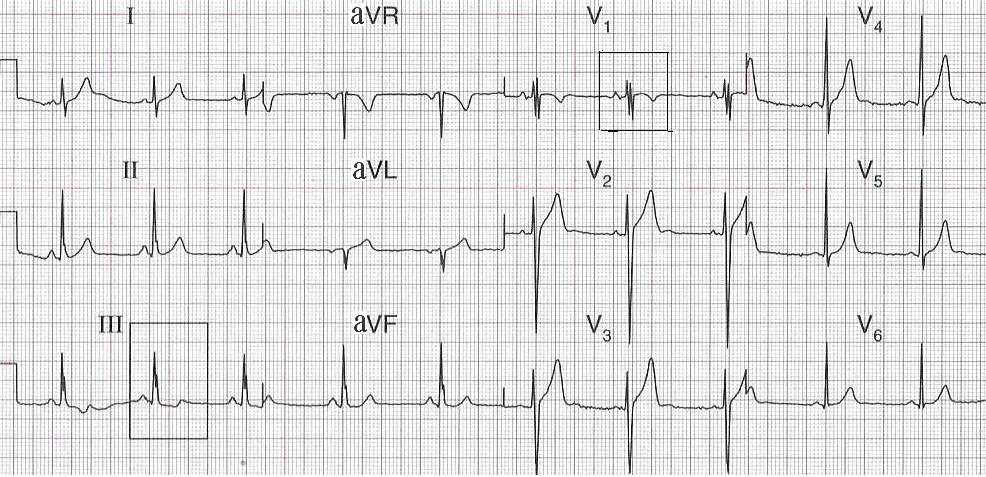 图46-9大致正常心电图(Ⅲ,v1的r波顿挫)