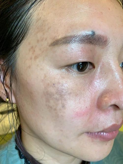 老顾客介绍过来的真皮斑,期待她的脱变吧.