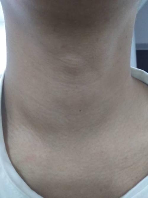 锁骨上方大约一指宽的地方有个肿块,昨天突然摸到的,之前好像都没有