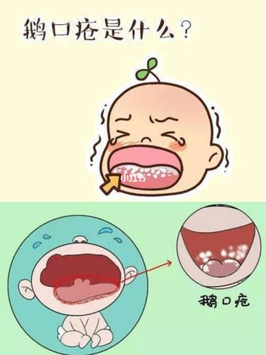 小儿鹅口疮是婴儿期很常见的症状,多见于周岁内的婴儿或新生儿,因为