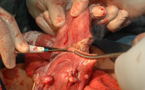 子宫切除手术有哪几个步骤