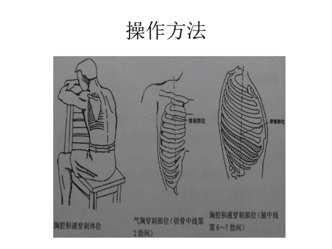 胸腔穿刺 中医基础理论.pdf 19页