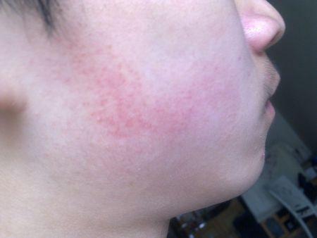 患者信息:男 16岁  病情描述(发病时间,主要症状等): 从小就有.