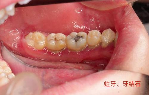 牙齿上出现「黑线」,你就要当心了