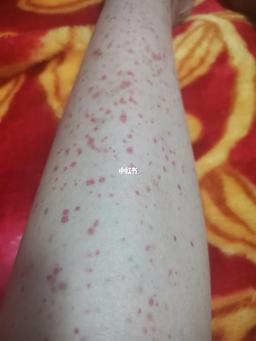 过敏性紫癜_过敏性紫癜_医疗健康_医疗健康其他