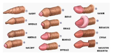 全面了解包茎知识