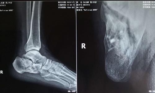 跟骨骨折关节镜下微创治疗