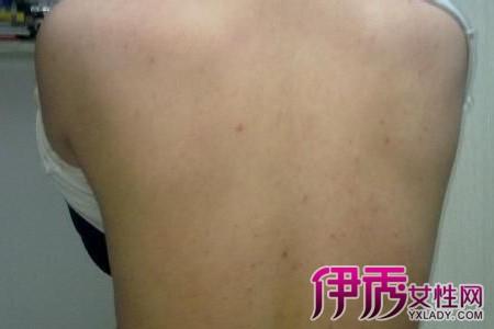 【图】艾滋病特征有哪些 5种方法教你辨别艾滋病