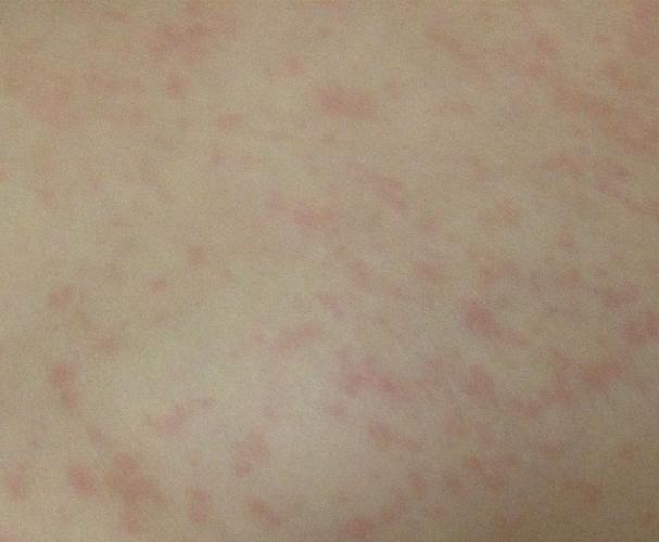 9月大 近几天病毒性发烧 吃了退烧药美林和泰诺林 退烧停药后起红疹