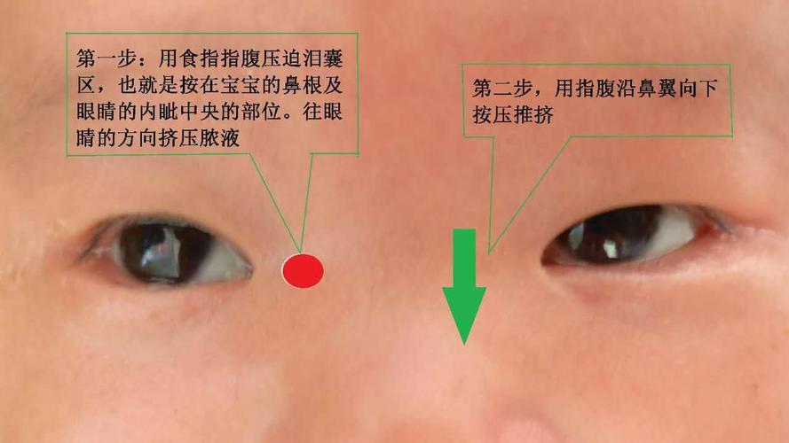 泪囊炎宝宝的新年愿望