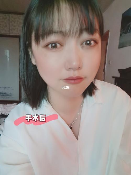 甲亢突眼前后对比_甲亢_减压_元旦去哪玩_突眼手术甲亢突眼手术眼眶