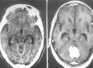 脑室受压移位是指ct检查或 a href="#" data-lemmaid="1270014">脑