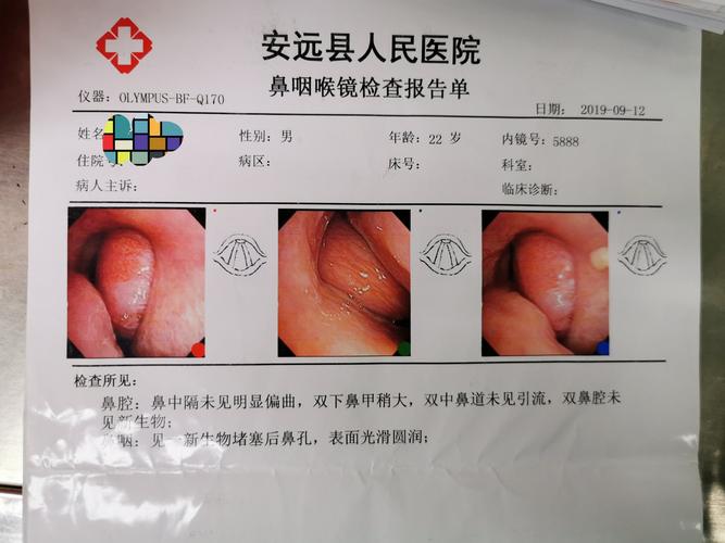 不忘初心,牢记使命:我科开展首例鼻咽纤维血管瘤切除术