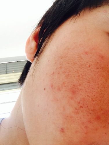 我的脸上长痘后,一直痘印疤都消不了,网友帮帮忙.