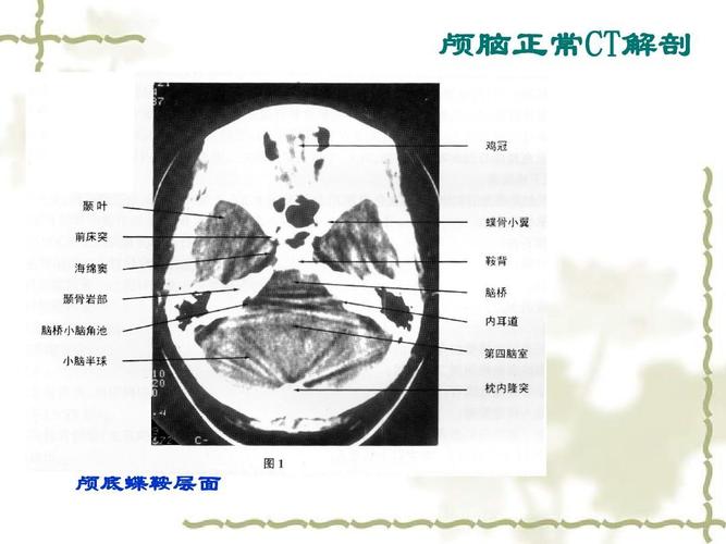 头部ct诊断学