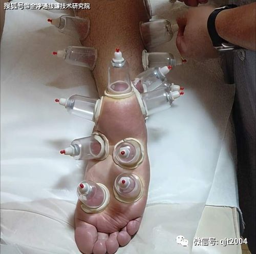 拔罐帮你祛风散寒,帮你保护好这两个部位!