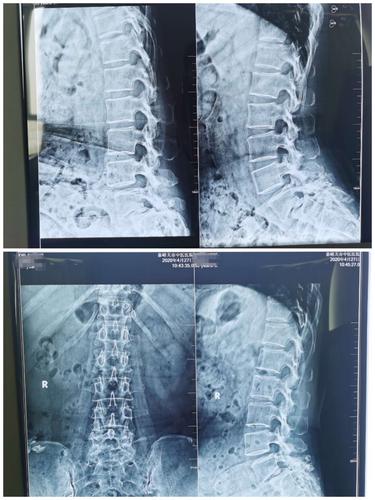 腰椎正侧位 动力位x线片