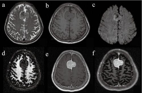 脑白质成像影像特征与常规mri比较