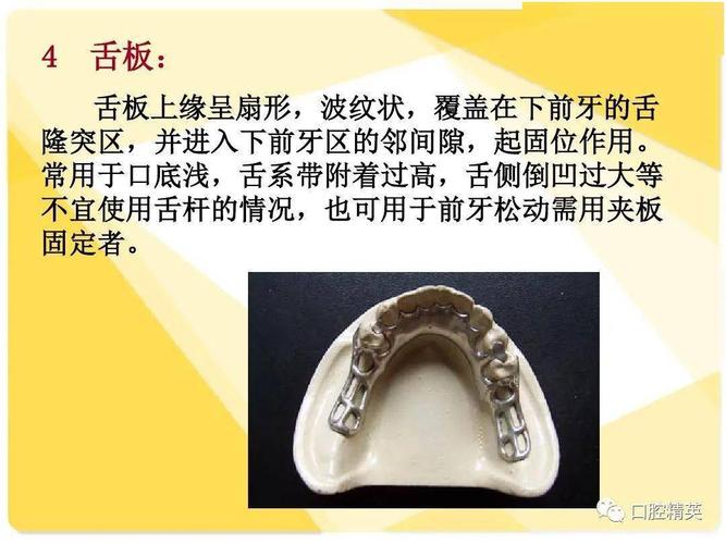 可摘局部义齿-结构